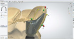 Figure 4  An abutment design scaling tool (anterior restoration).