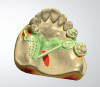 Figure 1   Classic presentation of the bruxism triad. Lateral wear pattern, generalized buccal tooth loss from erosion and abrasion, and history of sleep disruption.