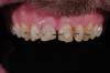 Figure 21   Mature patient with the bruxism triad. Lifetime history of bruxism, snoring, intermittent poor sleep, and GERD symptoms. Sleep study results indicate severe apnea.