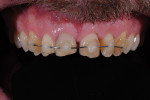 Figure 3  Composite and orthodontic wire placed by the oral surgeon to stabilize the author’s teeth.