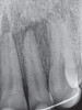 Figure 22  Incisal view demonstrates the damage from sleep bruxism and the erosive wear associated with GERD and tongue position.