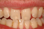 Figure 7  The author’s teeth prior to the accident, showing characterizations and imperfections.