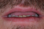 Figure 9: After the accident, the author had no tooth display in repose.