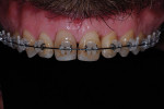 Figure 14  The first stage of orthodontic treatment.