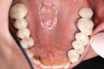 Figure 1  Maxillary occlusal view, posterior bridgework to be replaced by implants and single-unit PFM and PFM porcelain butt joints.