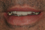 Figure 20  View of the maxillary provisionals in repose. Note: the patient is not anesthetized.