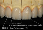 Figure 28  Powders were applied and then fired to mimic the internal effects of a natural tooth.