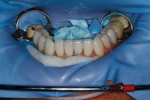 Figure 35  The mandibular IPS e.max restorations were bonded in.