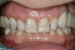 Figure 4  Retracted view with teeth in MIP. Note deep bite.
