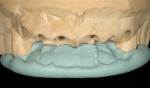 Figure 7  Cast with incisal reference.