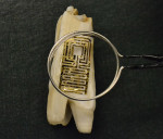 Figure 2  The wireless tooth.