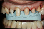 Figure 12  Incisal preparatory index used on maxillary anterior teeth to check incisal reduction. Incisal index was based on the second diagnostic wax-up.