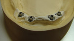 Figure 3  A working model with a removable polyurethane mask that was retained by three mini-magnets.