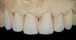 Figure 13  Fabrication of maxillary ceramic restorations.