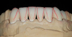 Figure 14  Fabrication of mandibular ceramic restorations.