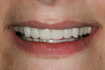 Figure 15  Full smile, “E” position. Maxillary and mandibular provisional restorations in place showing acceptable incisal edge position and esthetics.