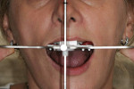 Figure 16  Transfer of the horizontal plane of the provisional restoration was completed using a Kois Dento-Facial Analyzer.