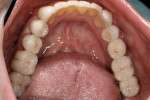 Figure 20  Maxillary occlusal view of permanent restorations in place.