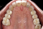 Figure 21  Maxillary arch retracted view showing natural esthetics and a more harmonious gingival architecture.