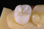 Figure 3  Example of maxillary tooth No. 2 from the Allure natural tooth library, printed in VeroWhite from the Objet Eden260V at 16-μm resolution.