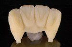 Figure 4  Lingual view of a printed mock-up at 16-μm resolution with matte finish. The 4-unit bridge for teeth Nos. 7 through 10 was designed, then printed, splitting the file so that the custom abutments and diagnostic proposal could be evaluated.