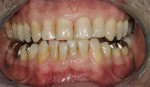 Figure 1  The patient presented with a restoration that was nearly 30 years old. The patient’s ideal was an esthetic, unnoticeable, and metal-free restoration.