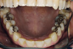 Figure 3  The patient presented with a restoration that was nearly 30 years old. The patient’s ideal was an esthetic, unnoticeable, and metal-free restoration.