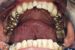 Figure 4  The patient presented with a restoration that was nearly 30 years old. The patient’s ideal was an esthetic, unnoticeable, and metal-free restoration.