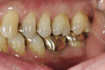 Figure 5  The patient presented with a restoration that was nearly 30 years old. The patient’s ideal was an esthetic, unnoticeable, and metal-free restoration.