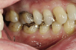 Figure 6  The patient presented with a restoration that was nearly 30 years old. The patient’s ideal was an esthetic, unnoticeable, and metal-free restoration.
