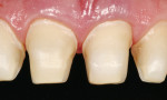 Figure 18  Palatally, it was only shortened incisally. In this way, a much stronger ceramic volume could be achieved compared with a palatal hollow. It would also protect the preparation border from additional tensions in the palatal concavity. The p