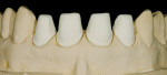 Figure 19  The impression of the prepared anteriors is cast twice, for a “Geller” model with loose dies as well as a solid master model.