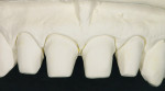 Figure 20  The impression of the prepared anteriors is cast twice, for a “Geller” model with loose dies as well as a solid master model.