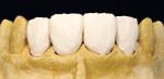 Figure 23  Full set-up with dentin-enamel, cut-back, and lengthening of the crown shape with enamel and transparent material.