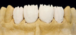 Figure 24  Full set-up with dentin-enamel, cut-back, and lengthening of the crown shape with enamel and transparent material.