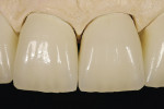 Figure 40  The remaining natural teeth should always be considered.