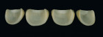 Figure 42  The finished veneers showed a thickness of 0.5 mm to 1 mm; therefore, only a small amount of the hard tooth substance had to be sacrificed.