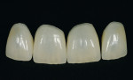 Figure 43  The finished veneers showed a thickness of 0.5 mm to 1 mm; therefore, only a small amount of the hard tooth substance had to be sacrificed.