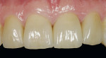 Figure 45  A few days after the definitive incorporation, the teeth re-hydrated and the soft tissue relaxed. The restoration looks very natural and lively.