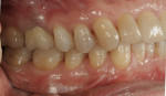 Figure 46  A few days after the definitive incorporation, the teeth re-hydrated and the soft tissue relaxed. The restoration looks very natural and lively.