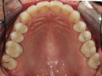 Figure 48  A few days after the definitive incorporation, the teeth re-hydrated and the soft tissue relaxed. The restoration looks very natural and lively.