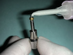 Figure 1  Cement being added to the threads of the abutment.