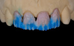 Figure  9  Dentin, enamels, and translucents were built to frame tooth shape and create the canvas upon which the other ceramic materials would be layered.