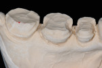Figure  7  Although conceptually acceptable, these preparations have been left with sharp angles and undercuts. The final restorations will have an acceptable thickness, but the inner surface will remain under tensile stress.