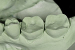 Figure  9  A solid model of the master impression is poured and kept aside for final fitting and verification of the restorations.