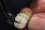 Figure  11  This restoration was fabricated as an exercise to develop a better understanding and mastery of how to transition the color of the natural prepared tooth to an all-ceramic restoration. The specimen was preserved to maintain its natural co