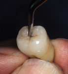 Figure  12  When seated on the preparation site, the restoration becomes almost indistinguishable from the natural tooth specimen.