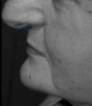 Figure 4  Figure 1 has been digitally altered by rotating the nasal tip downward to show the effect of an acute nasolabial angle on the perception of 