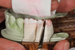 Figure  19  The application of a white enamel material is an effective and simple way of reproducing the posterior enamel.