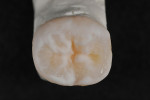 Figure  24  To create a more natural-looking restoration, special incisal materials with a higher concentration of white can be applied to further express the whitish character of the ridges.